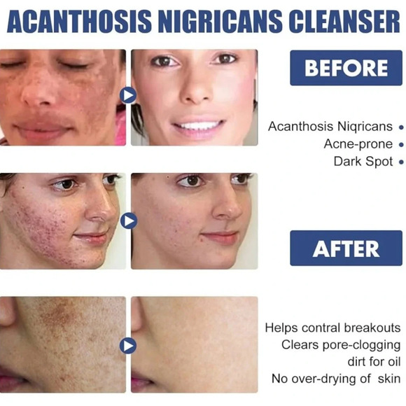 NWT Acne and Spots Cleansing Lotion Relief 50ml for Dry Skin Facial Cleanser - Picture 4 of 11